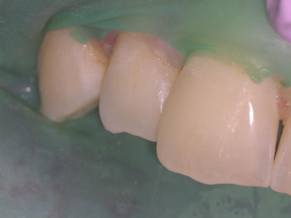 Эстетическая реставрация переднего зуба