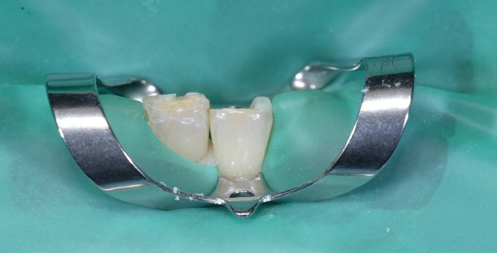 Эстетическая реставрация передних зубов нижней челюсти