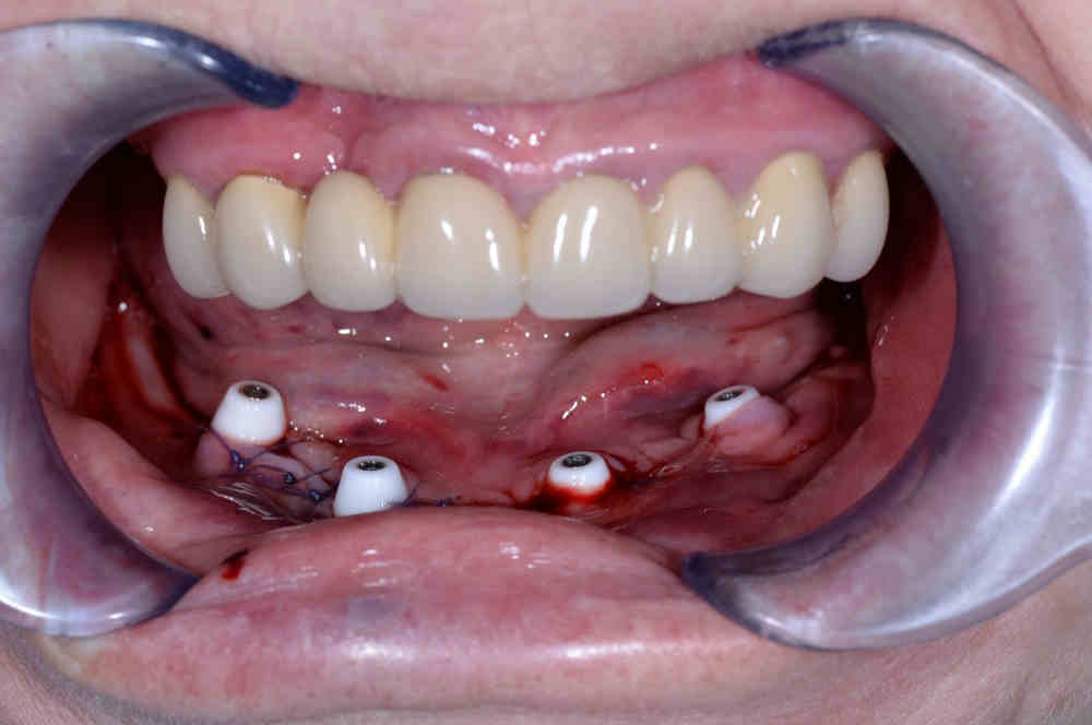 Всего 4 импланта для восстановления зубов на нижней челюсти 