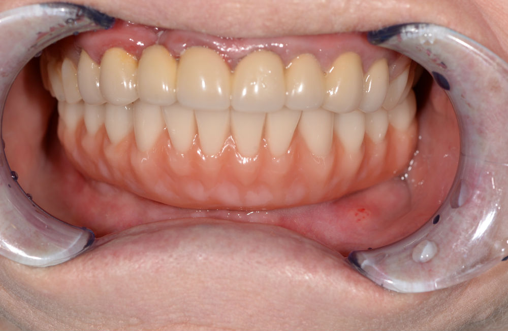 Всего 4 импланта для восстановления зубов на нижней челюсти 