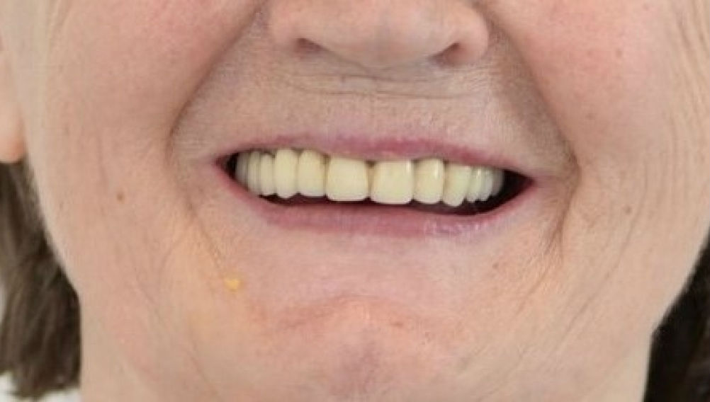 Восстановление зубов на нижней челюсти по методу All-on-4