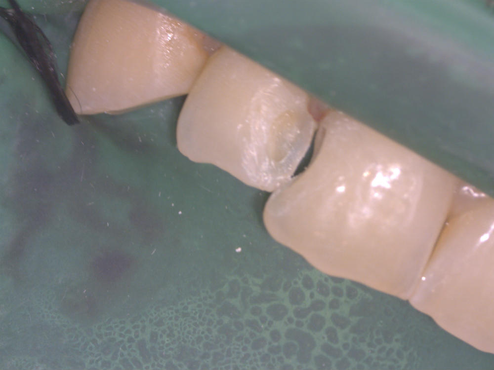 Эстетическая реставрация переднего зуба