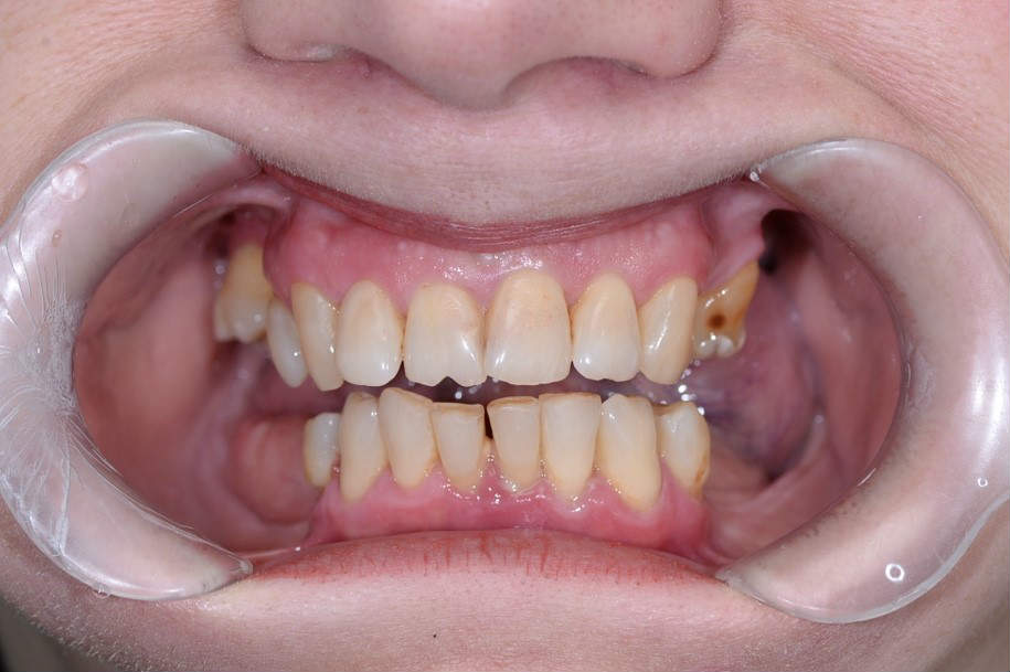Восстановлении зубного ряда нижней челюсти на четырех имплантах по технологии All on 4