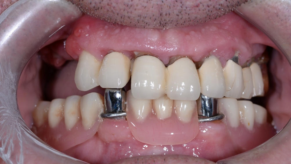 Полное восстановление зубов на нижней и верхней челюсти за 1 месяц