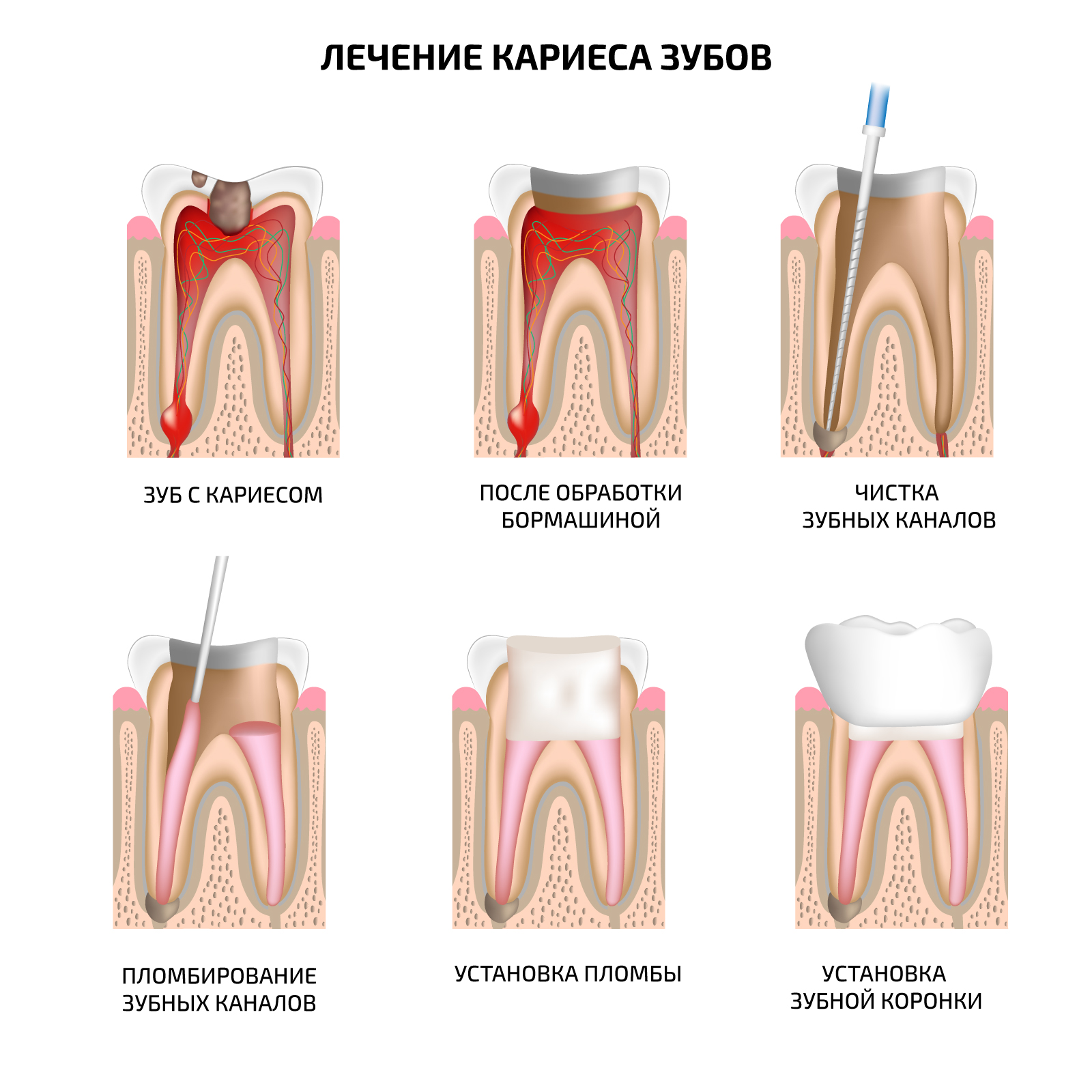 иллюстрация лечения кариеса, обработка зуба, чистка каналов и пломбирование