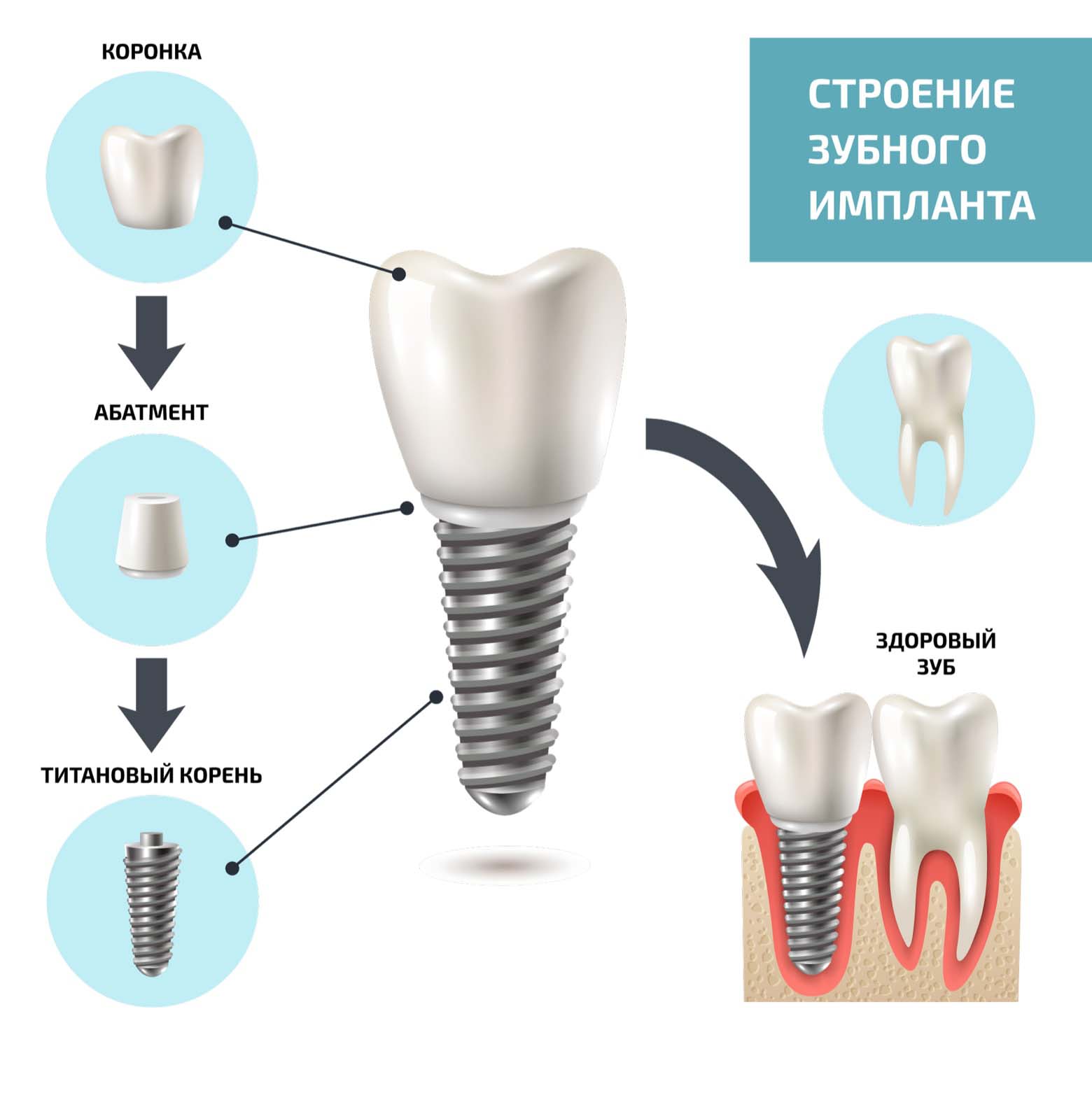 Имплант строение схема