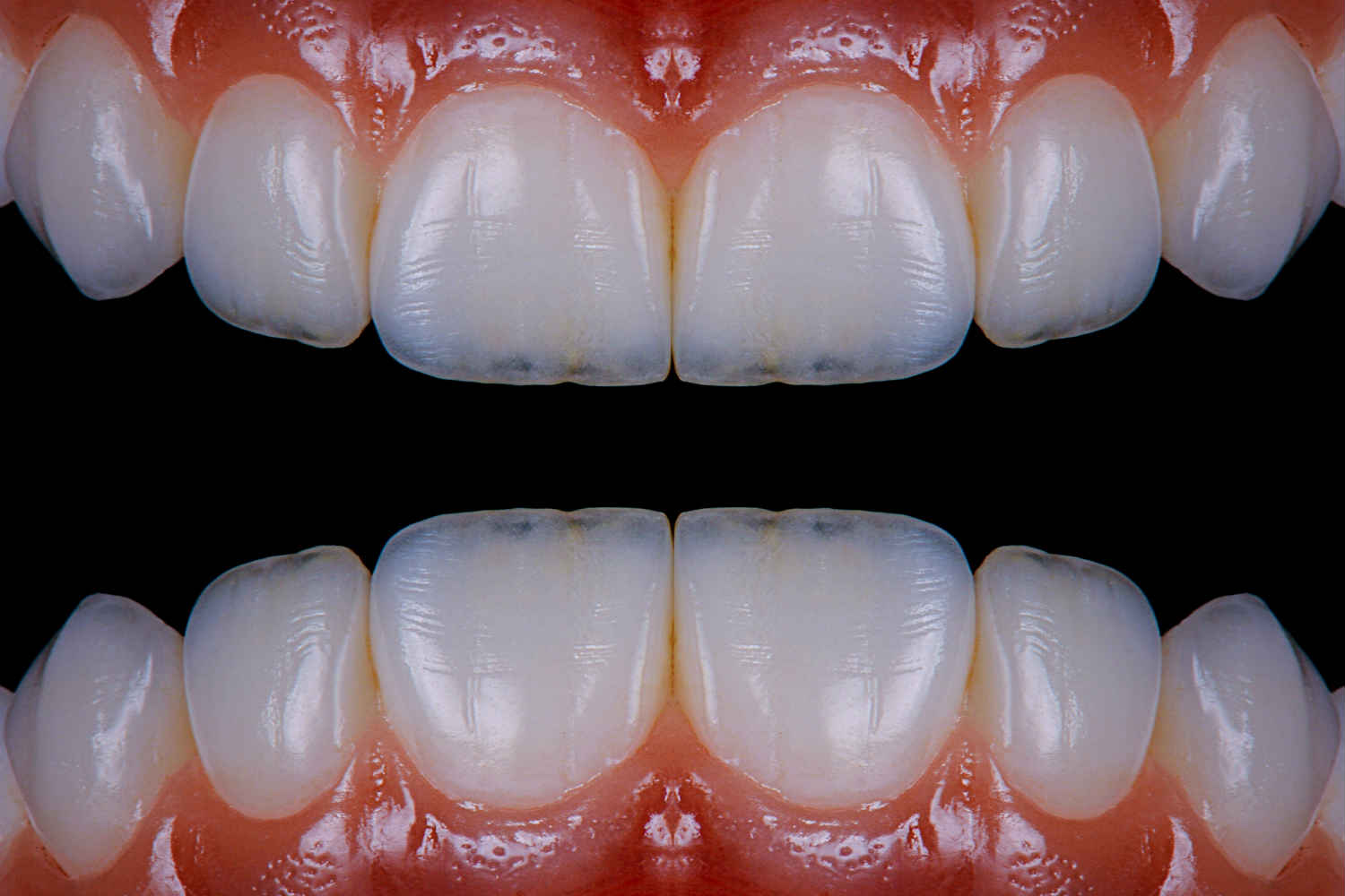 Керамические зубы на передние зубы фото