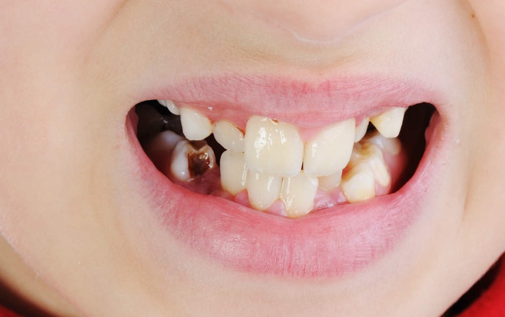 Откололся кусок зуба и остался в десне. Какие процедуры предстоят?