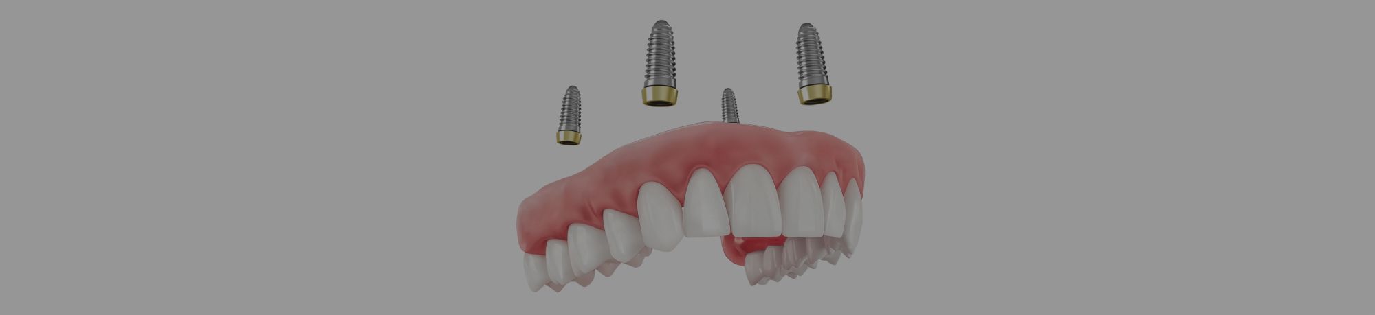Имплантация All-on-4: преимущества и недостатки, показания, протокол и этапы