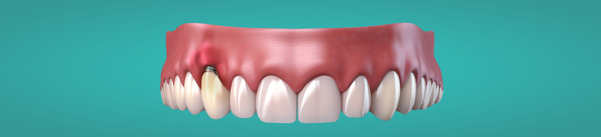 Отторжение импланта зуба: причины, симптомы, лечение