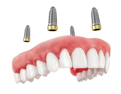 Имплантация All-on-4: преимущества и недостатки, показания, протокол и этапы