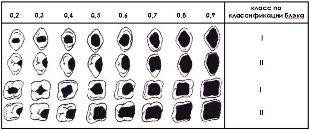 Классификация по блэку. Индекс разрушения окклюзионной поверхности зуба ИРОПЗ. Степень разрушения зуба ИРОПЗ. Классификация кариеса по ИРОПЗ. Разрушение коронки зуба ИРОПЗ.