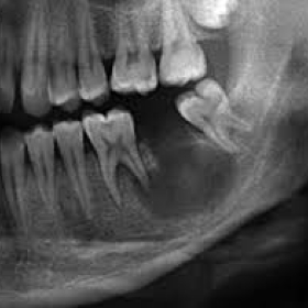 Симптомы кисты зуба